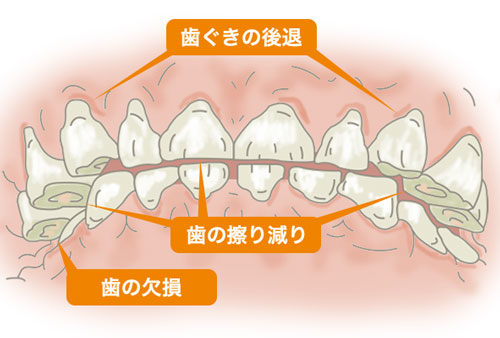 歯ぎしり・食いしばりの歯へのダメージ