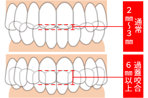 インビザラインのようなアライナーをオーバーバイトやオーバージェットの矯正に使用できますか?