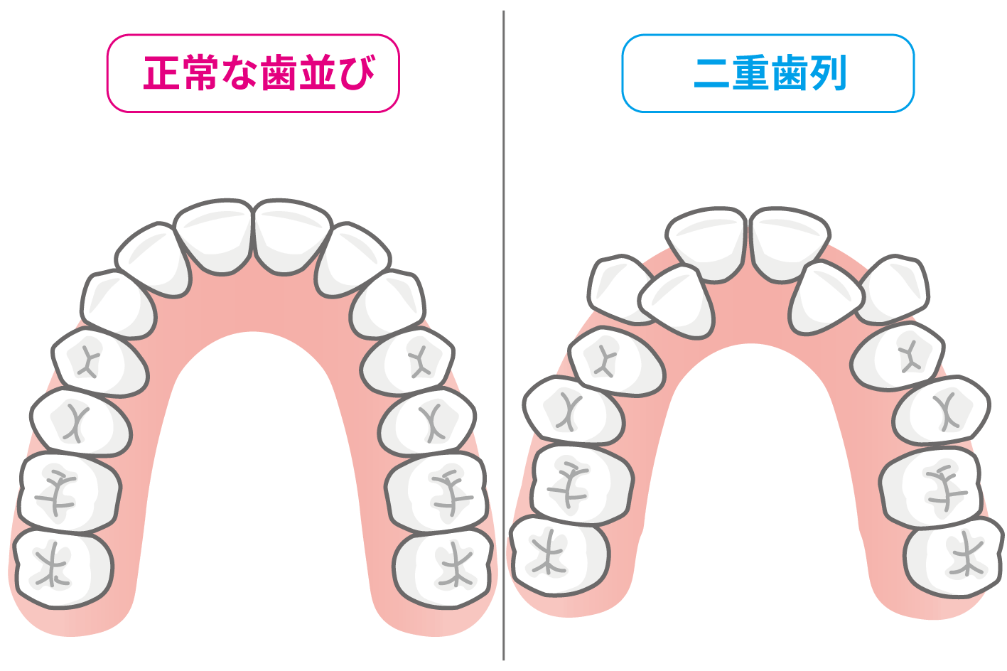 正常な歯並びと二重歯列の比較イラスト