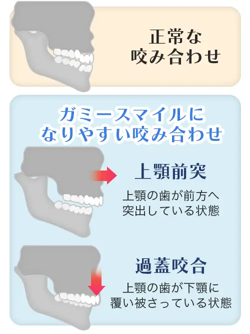 ガミースマイルになりやすい咬み合わせの図