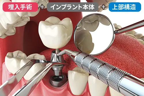 インプラントの費用相場を比較しているイメージ