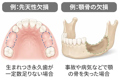 インプラントが保険適用となるケースの例