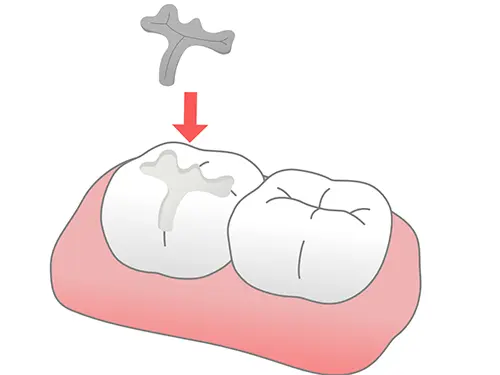 銀の詰め物の再接着イメージ