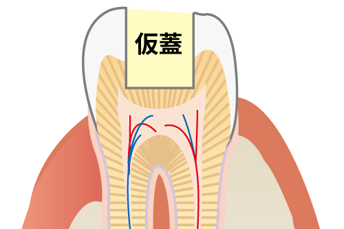 治療後の仮蓋の