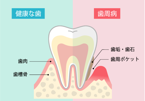 健康な歯と歯茎、歯周病の歯と歯茎