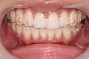 すきっ歯の悩みを解消する4つの治療法 アップル歯科尼崎駅前