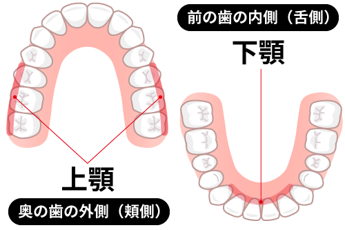 歯石が溜まりやすい場所の図解